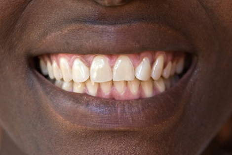 Natural teeth